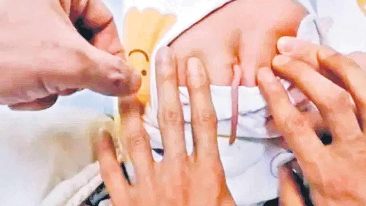 Tethered Spinal Cord | తోకతో జన్మించిన శిశువు.. తొలగిస్తారా? అలాగే ఉంచుతారా?