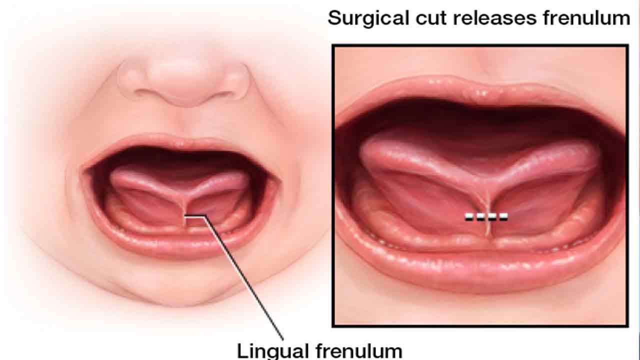 Tongue Tie | టంగ్‌ టైతో జన్మించేవారికి శస్త్రచికిత్స అవసరమా?