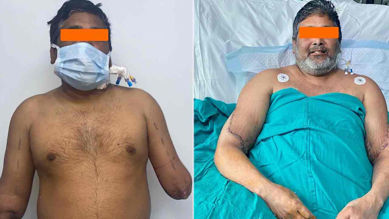 Hand Transplantation: అరుదైన సర్జరీ.. పెయింటర్కు రెండు చేతుల్ని అమర్చిన ఢిల్లీ డాక్టర్లు