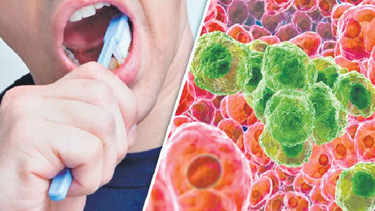 Colon Cancer | పొద్దున్నే బ్రష్‌ చేసుకోకపోతే పెద్దపేగు క్యాన్సర్‌!