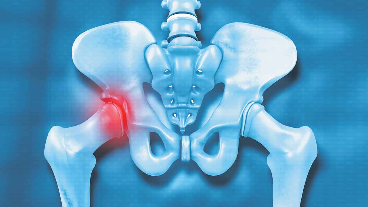 Avascular Necrosis | తుంటి తెచ్చే తంటాలు