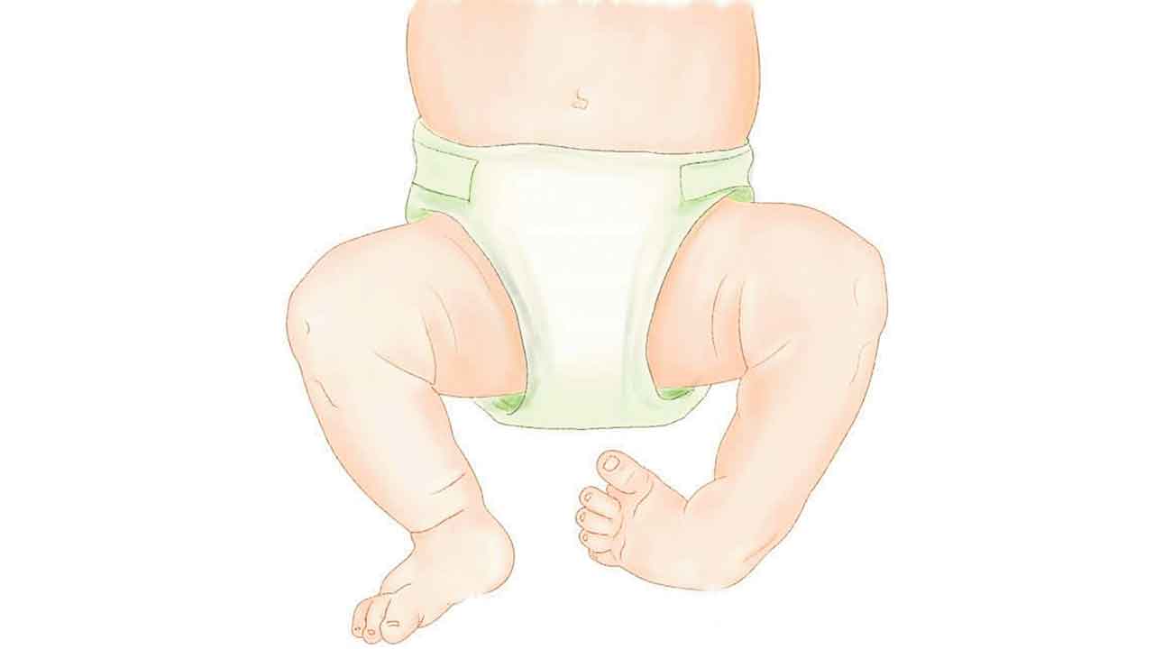 Parenting | మా బాబుకు పుట్టుకతోనే  వంకర పాదాలు.. భవిష్యత్తులో ఇంకేమైనా సమస్యలు వస్తాయా?