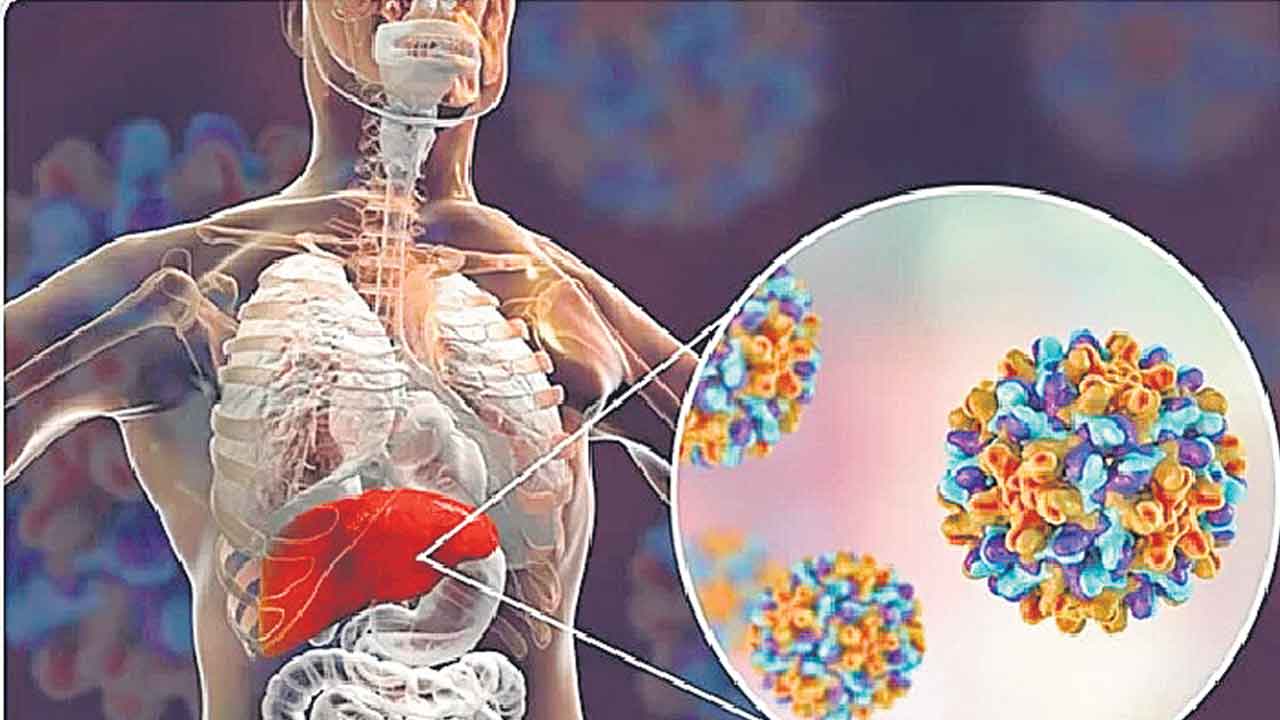 Hepatitis | కబళిస్తున్నహెపటైటిస్‌.. భారత్‌లో రికార్డు స్థాయిలో కేసులు