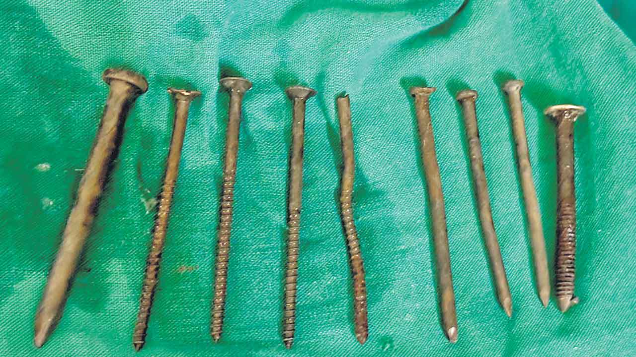 Hyderabad | ఖైదీ కడుపులో తొమ్మిది మేకులు.. తొలగించిన గాంధీ వైద్యులు