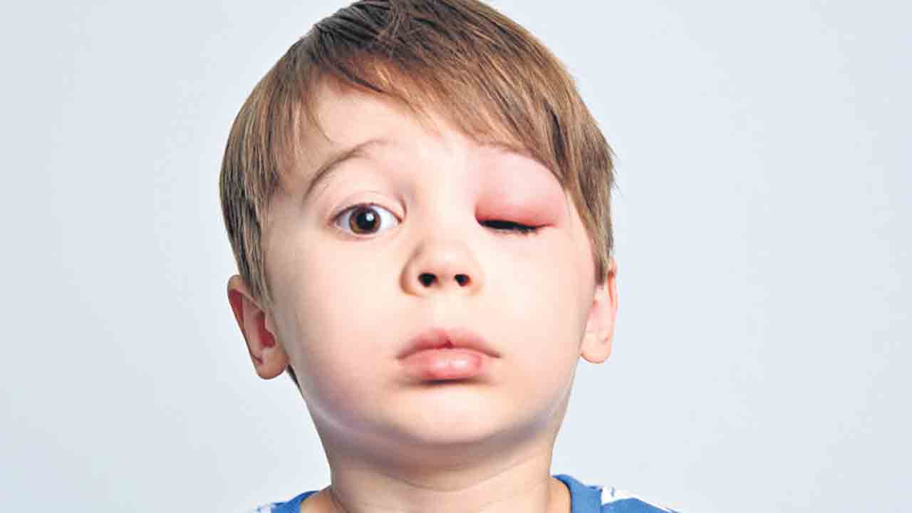 కంటి ఇన్ఫెక్షన్‌కు సీటీ స్కాన్‌ అవసరమా?