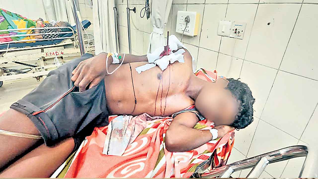 NIMS | ఊపిరితిత్తులను చీల్చి.. గుండె అంచున.. యువకుడి ఛాతిలో చిక్కుకున్న బాణం
