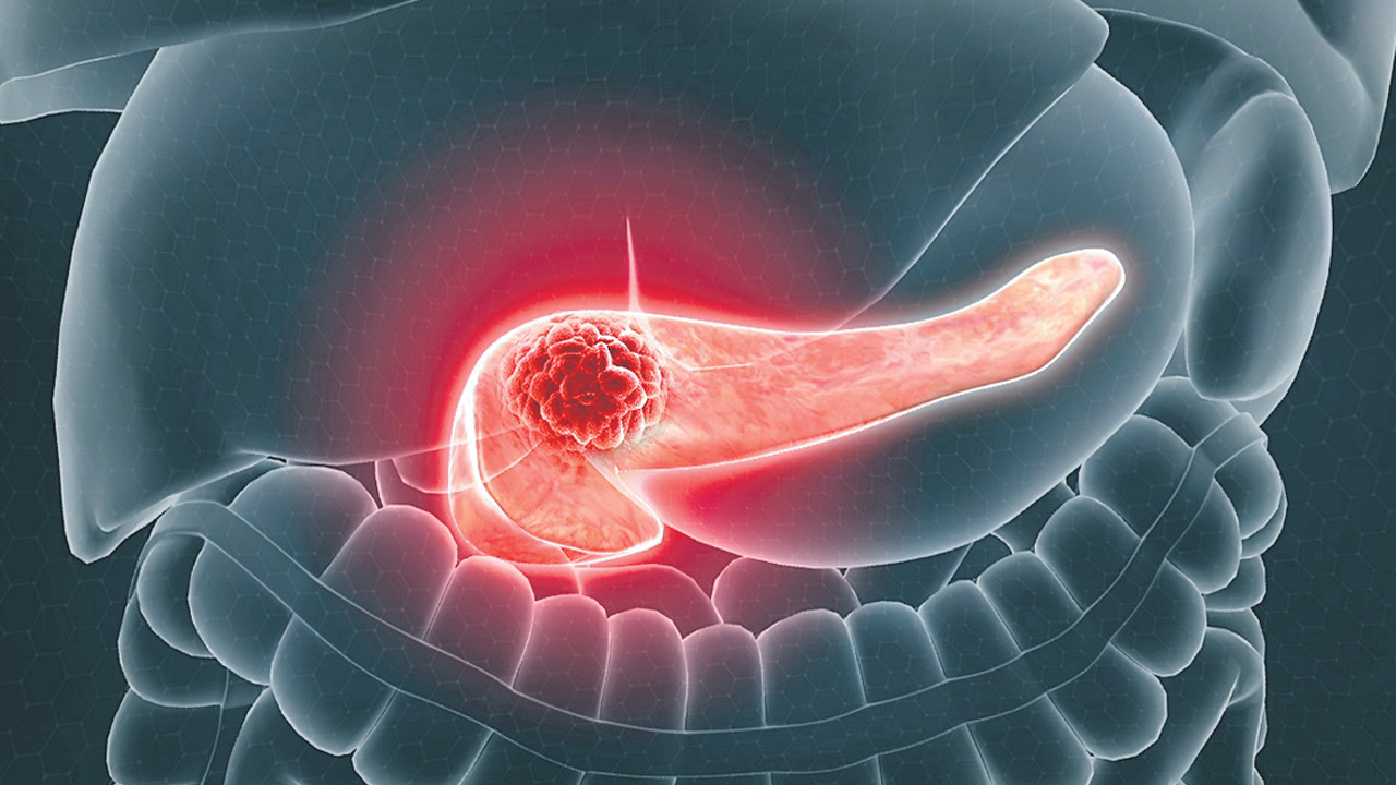 Pancreatic cancer | రక్త పరీక్షతో పాంక్రియాటిక్‌ క్యాన్సర్‌ నిర్ధారణ