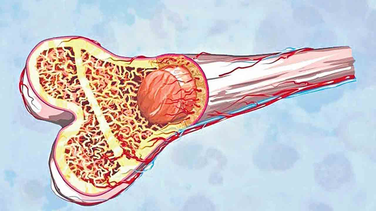 రక్త క్యాన్సర్‌పై బ్రహ్మాస్త్రం ఎముక మూలుగ మార్పిడి