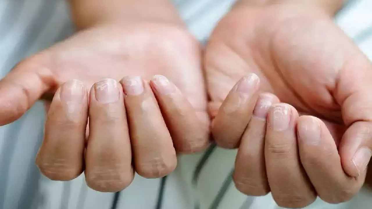 Cancer | మీ గోళ్లపై ఇలా చారలు ఏర్పడుతున్నాయా? క్యాన్సర్‌ రావొచ్చు జాగ్రత్త!