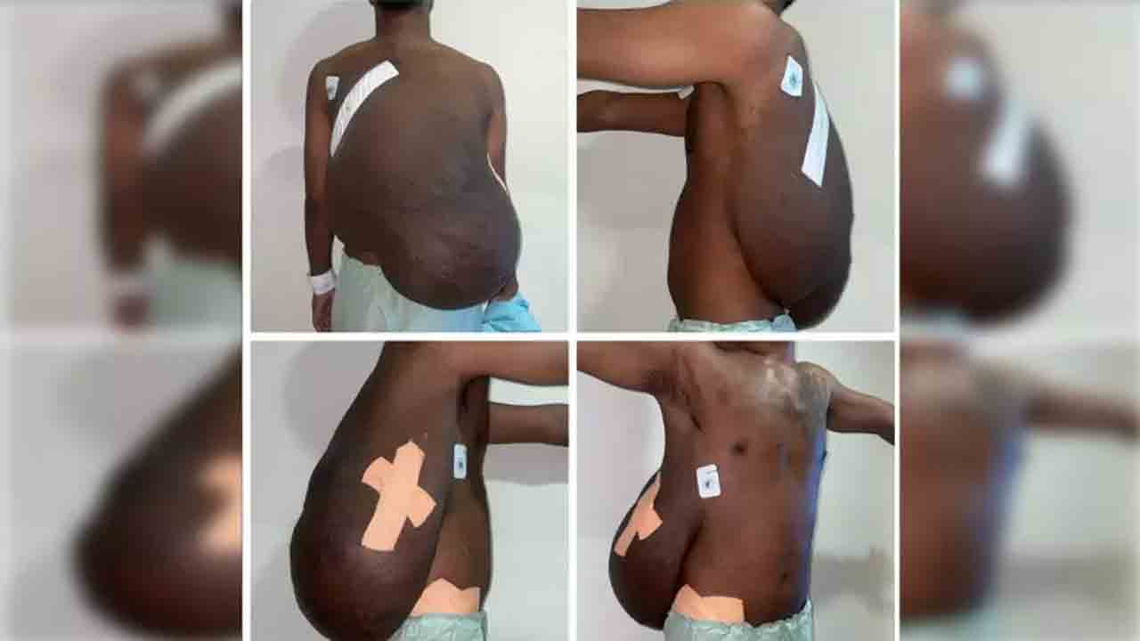 Gunny Bag Size Tumour Removed | వ్యక్తి వెనుక వైపు గోనె సంచి పరిమాణంలో కణితి.. పది గంటలు   శ్రమించి తొలగించిన డాక్టర్లు