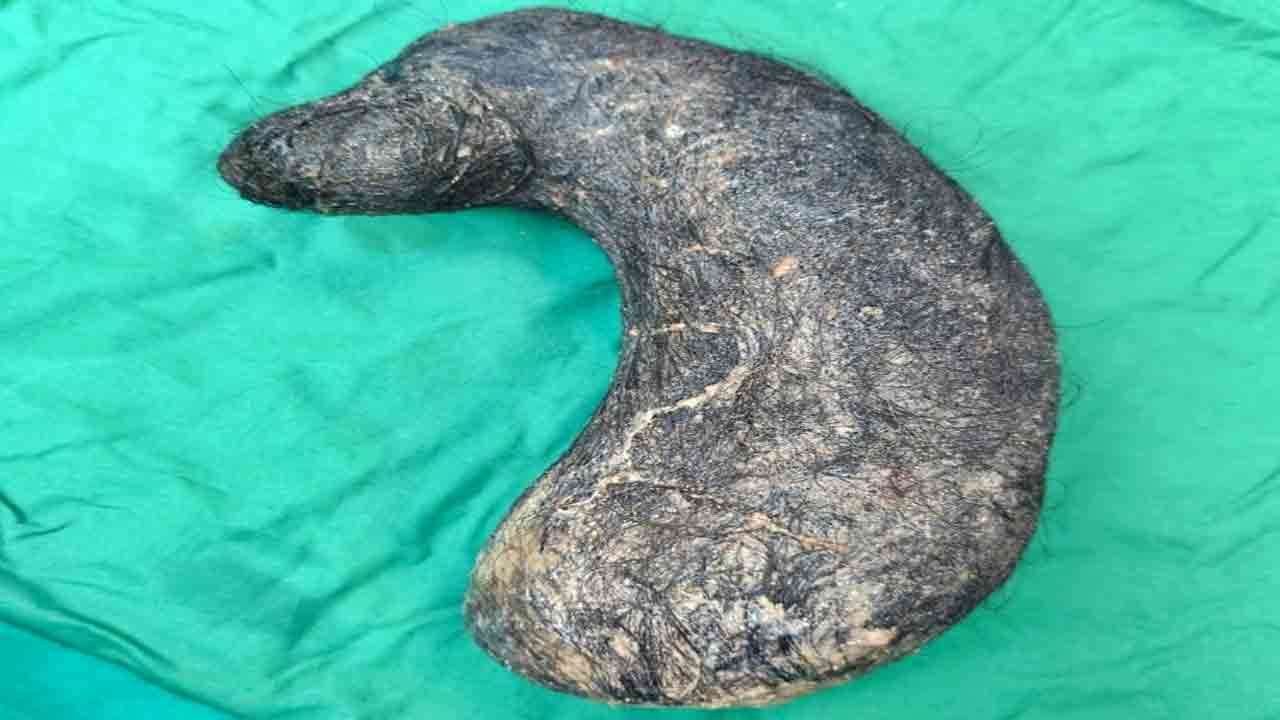 Hair In Stomach