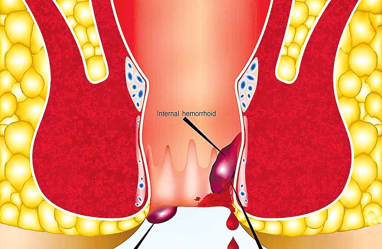 Hemorrhoids Symptoms