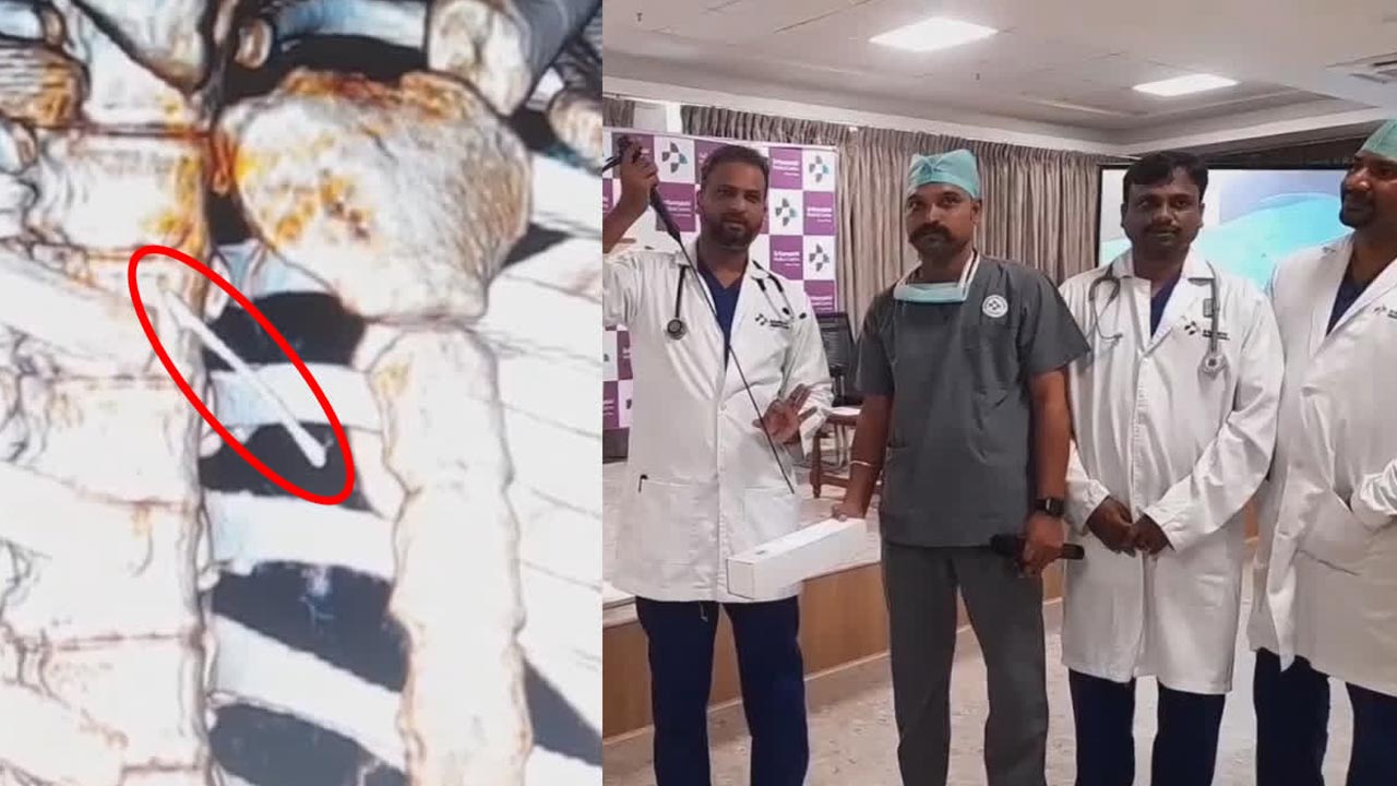 Tamil Nadu Doctors | పొరపాటున సూది మింగిన బాలిక.. సర్జరీ లేకుండా రికార్డు టైమ్‌లో తొలగించిన వైద్యులు