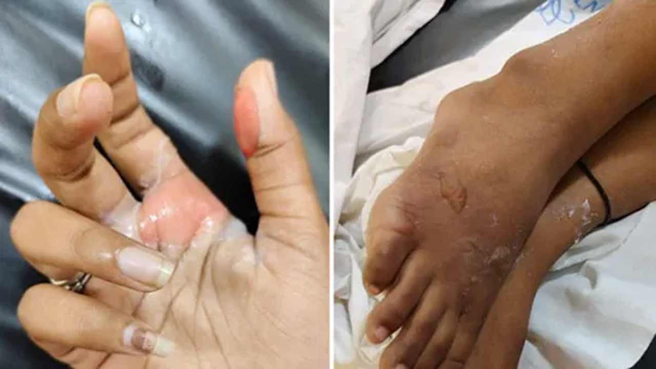 Hyderabad | ఇక్ఫాయ్‌ విద్యార్థినిపై యాసిడ్‌ దాడి కేసులో ట్విస్ట్‌.. వర్సిటీ వీసీ ఏం చెబుతున్నారంటే..!