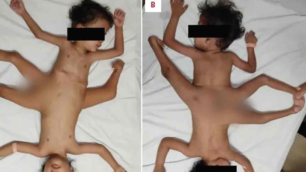 Conjoined Twins: 4 చేతులు, 3 కాళ్ల‌తో అరుదైన అవిభ‌క్త క‌వ‌ల‌లు జ‌న‌నం