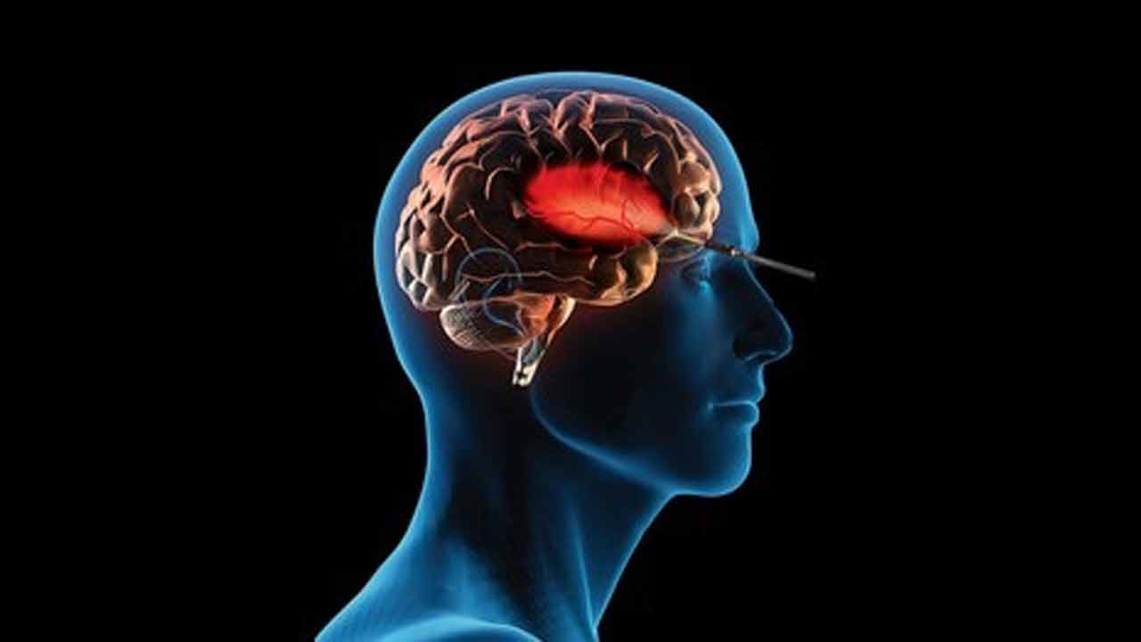 Keyhole Surgery | చెన్నై వైద్యుల ఘనత.. ప్రపంచంలోనే మొదటిసారిగా కీహోల్‌ సర్జరీతో మెదడులో కణితి తొలగింపు