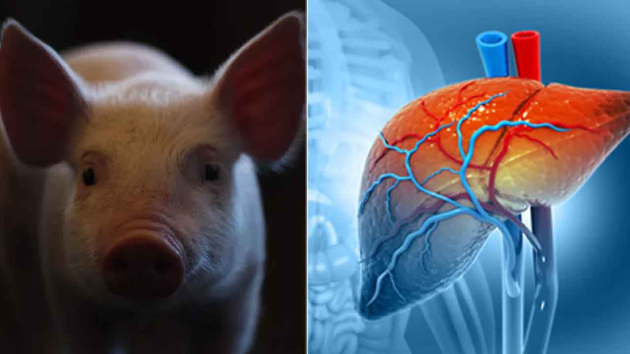 మనిషికి పంది కాలేయం మార్పిడి