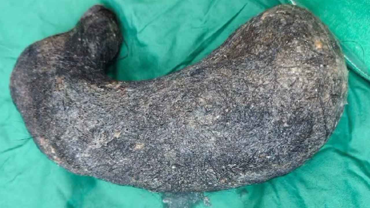 మహిళ కడుపులో 2.5 కిలోల వెంట్రుకలు