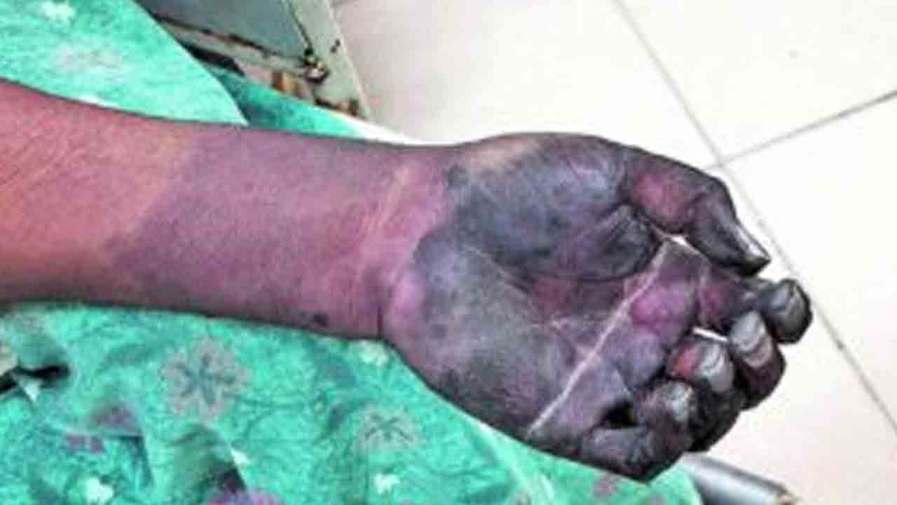 వచ్చీరాని వైద్యం.. చెయ్యి మాయం!