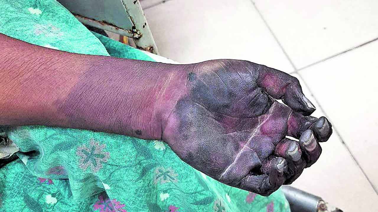 వికటించిన వైద్యం