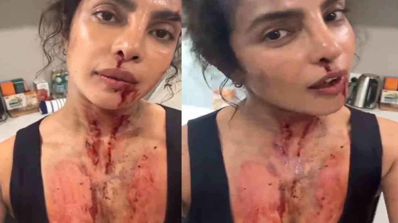 Priyanka Chopra | షూటింగ్‌లో గాయాలతో ప్రియాంక చోప్రా.. వీడియో వైర‌ల్