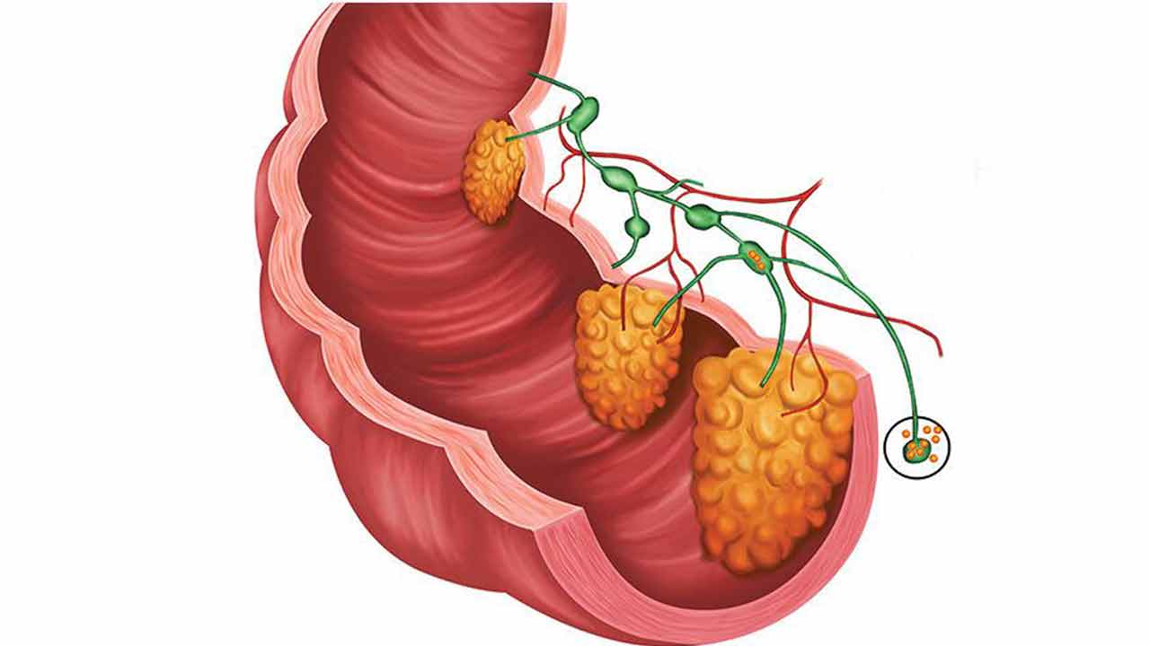 మలంలో రక్తం.. పేగు క్యాన్సర్‌ కావొచ్చు!