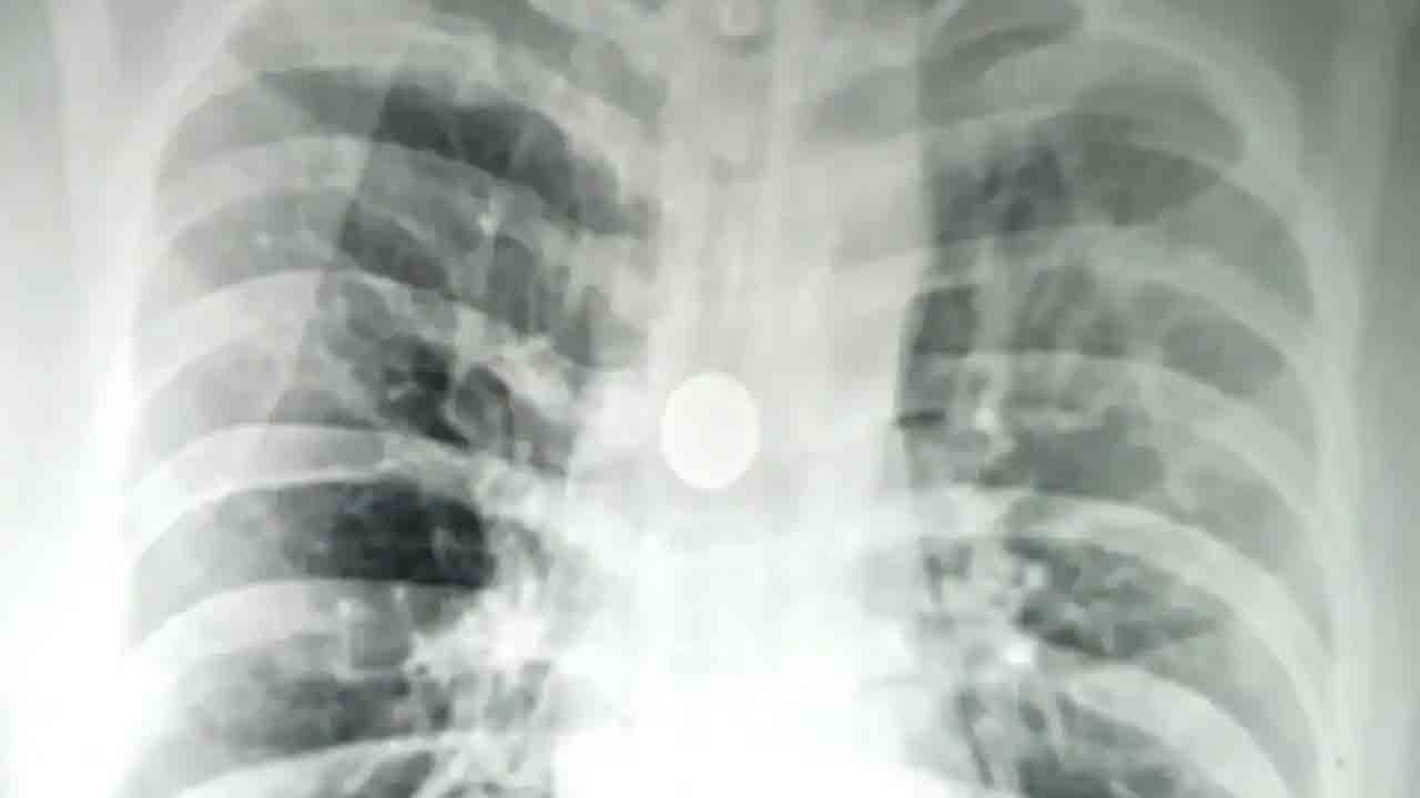 25 Paise Coin Stuck | ఎనిమిదేళ్లుగా శ్వాసనాళంలో 25 పైసల నాణెం.. తొలగించిన డాక్టర్లు