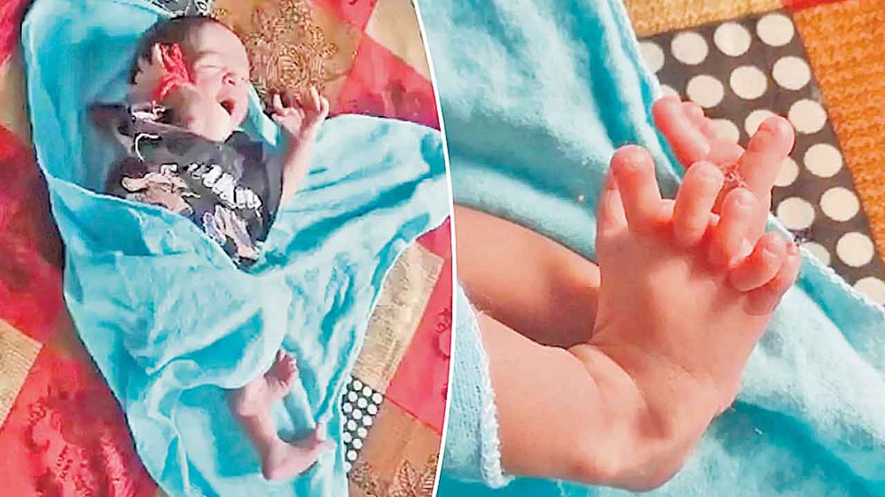 25 వేళ్లతో అరుదైన శిశువు జననం