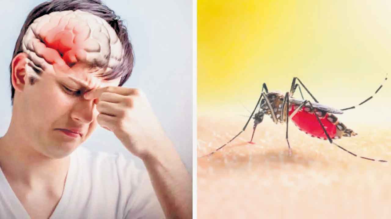 Brain Stroke | డెంగ్యూతో బ్రెయిన్‌ స్ట్రోక్‌ ముప్పు