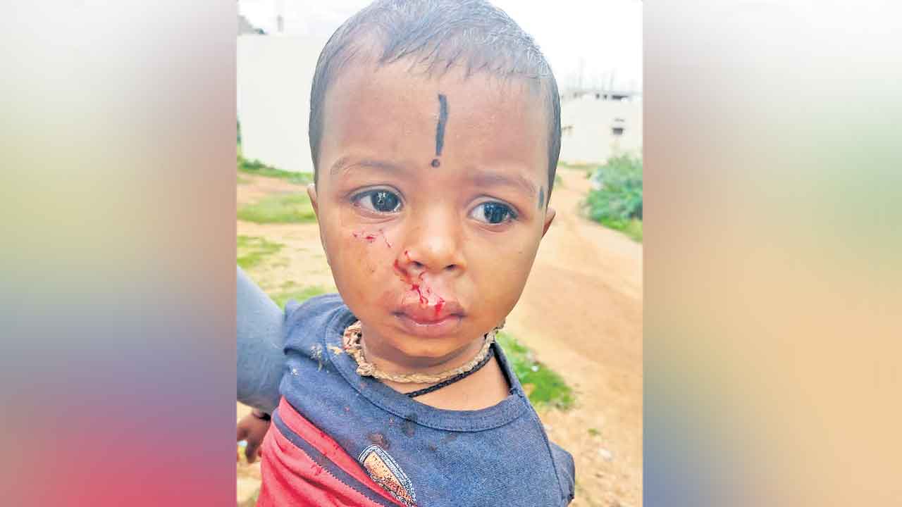 కుక్కల దాడిలో బాలుడికి గాయాలు