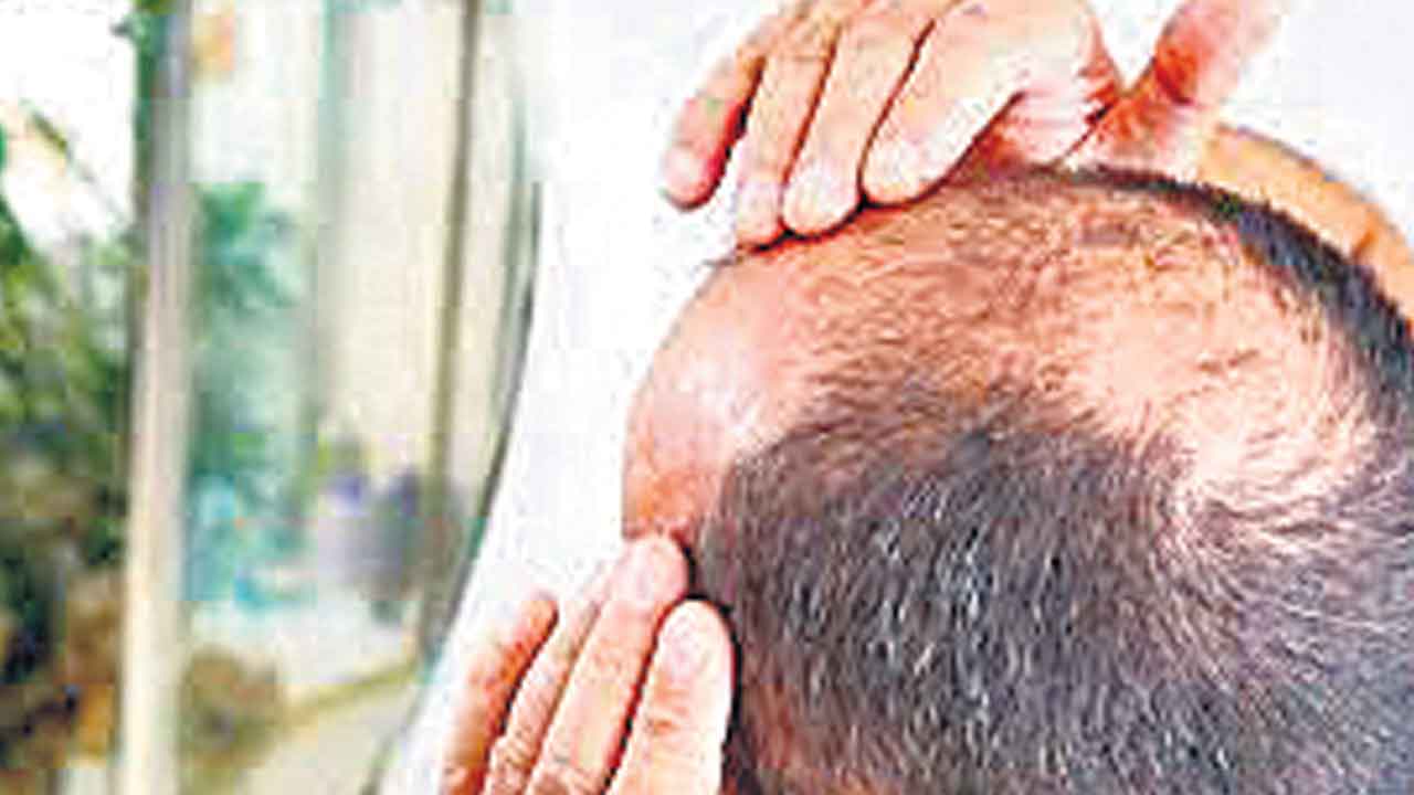 Baldness | బట్టతలతో బాధపడుతున్నారా.. మీ సమస్యకు చక్కెరతో చెక్‌!