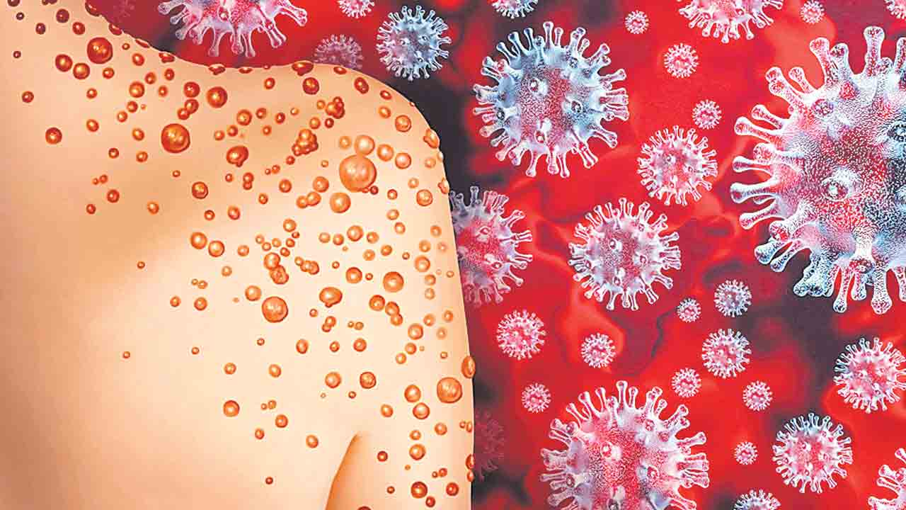 Monkeypox | ఎంపాక్స్‌ కలవరం.. గ్లోబల్‌ హెల్త్‌ ఎమర్జెన్సీ ప్రకటించిన డబ్ల్యూహెచ్‌వో
