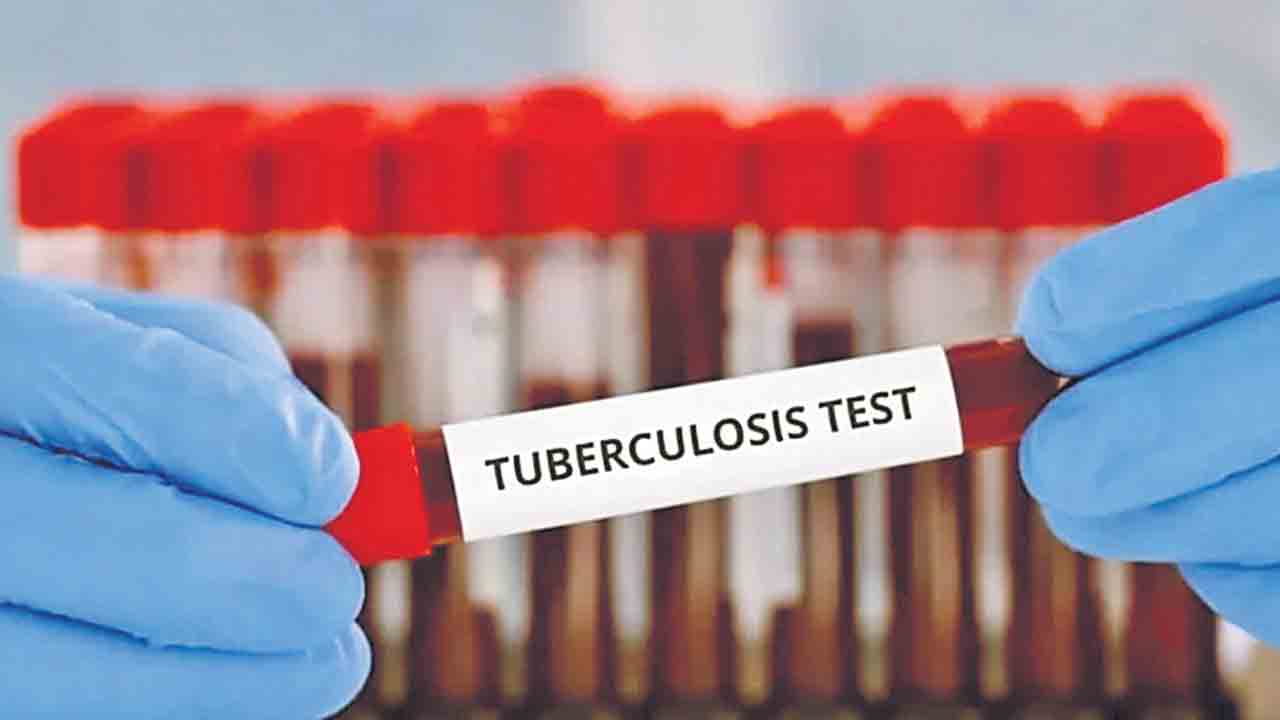 TB Test | రూ.35కే టీబీ పరీక్ష.. రెండున్నర గంటల్లో ఫలితం