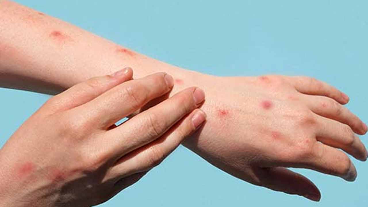 MPox | మంకీపాక్స్‌ ఎక్కువగా ఈ వయసుల్లో వారికే సోకుతుందట..! ఎలాంటి లక్షణాలు కనిపిస్తాయంటే..?