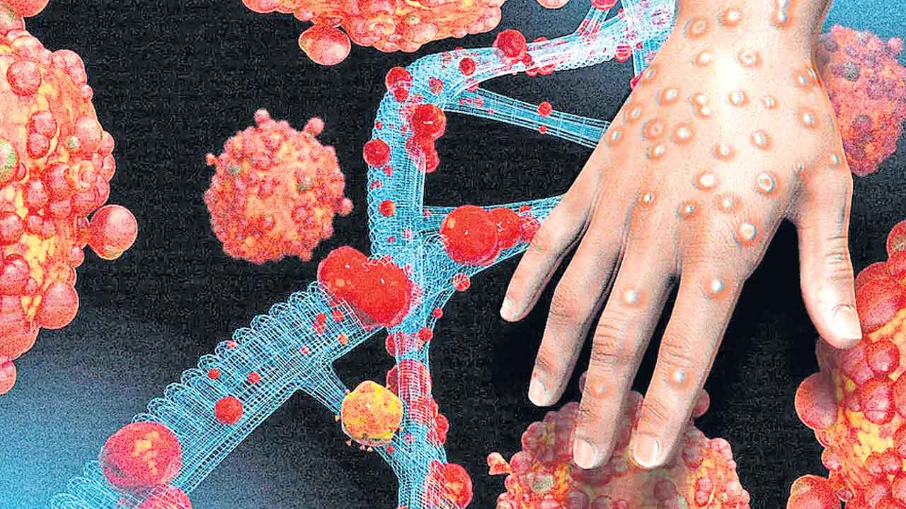 Monkeypox | ప్రపంచ ఆర్థికానికి మంకీ భయం.. కొవిడ్‌నాటి దుస్థితి దాపురించవచ్చంటున్న నిపుణులు