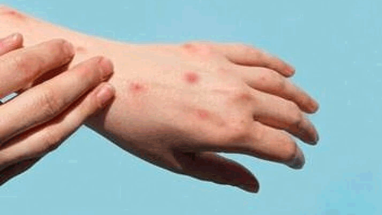 Monkeypox | ఆఫ్రికా దేశాలను వణికిస్తున్న ఎంపాక్స్‌.. భారత్‌లో అనుమానిత కేసు?