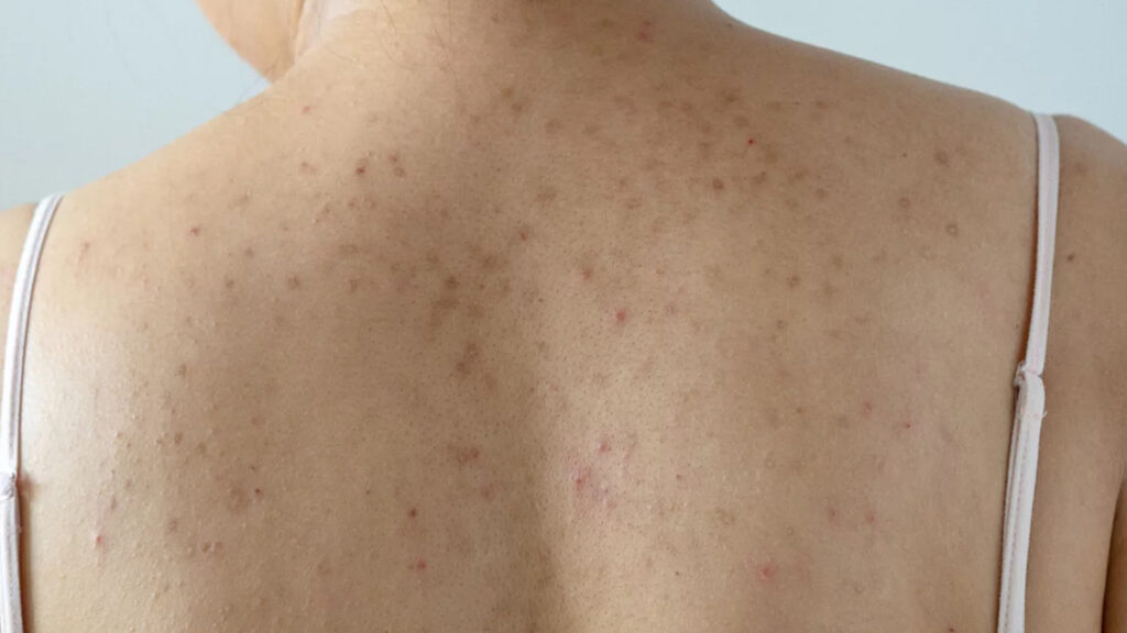 Black Heads