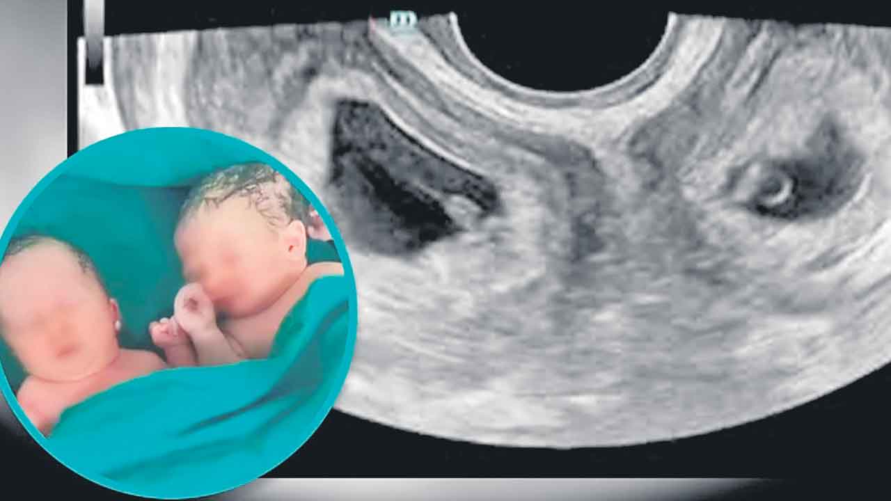 China | చైనా మహిళకు రెండు గర్భాశయాలు.. రెండింటి ద్వారా శిశువుల జననం