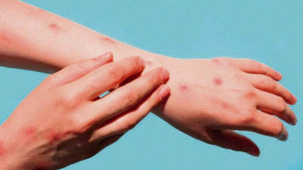 Monkeypox case | మళ్లీ మంకీపాక్స్‌ కలకలం.. కేరళలో మరో కేసు నమోదు..!