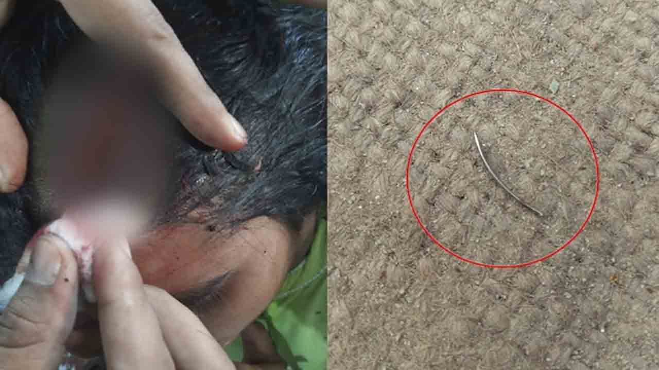 Surgical Needle Inside Woman’s Head | మహిళ తలలో సర్జికల్ సూది మరిచిన డాక్టర్‌.. తర్వాత ఏం జరిగిందంటే?