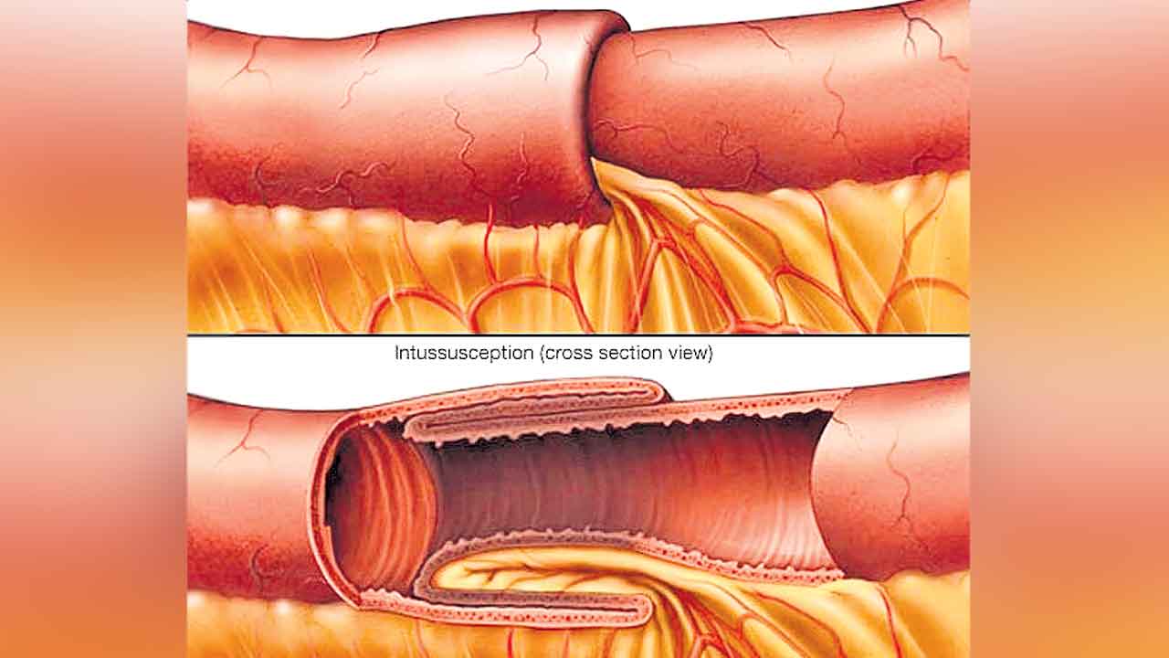 ఒక పేగు మరో పేగులోకి చొరబడితే..