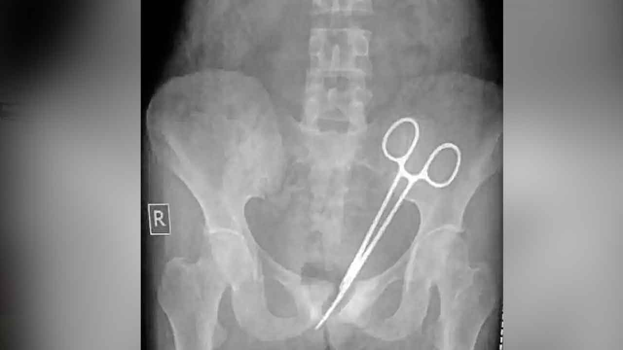 Scissors | ఆపరేషన్‌లో మరచి.. 12 ఏండ్లుగా కడుపులో కత్తెర