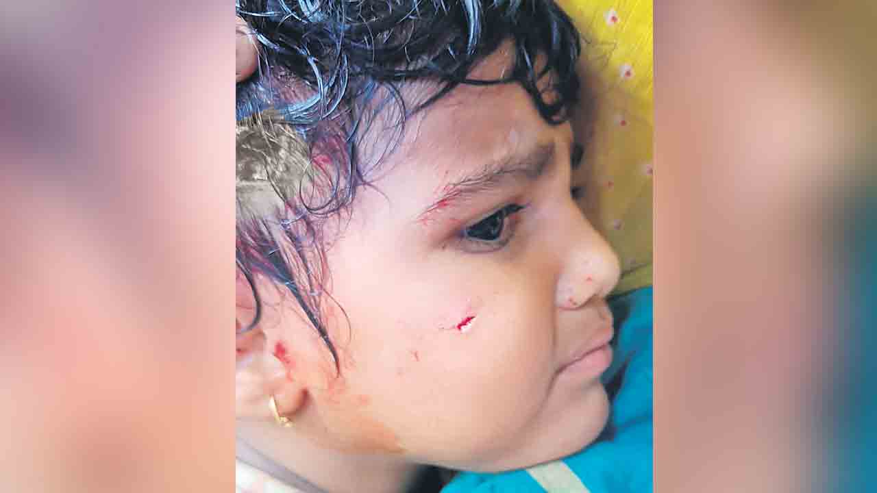 చిన్నారిపై వీధి కుక్కల దాడి