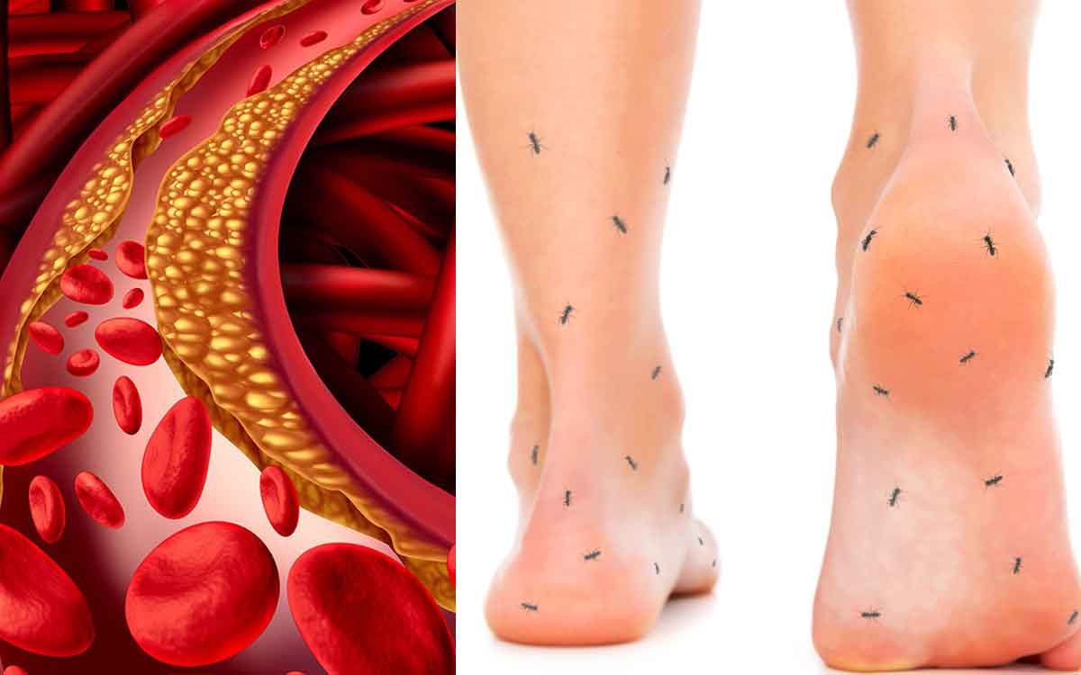 High Cholesterol Symptoms In Legs | కొలెస్ట్రాల్ ఎక్కువ‌గా ఉంటే కాళ్ల‌లో ఈ ల‌క్ష‌ణాలు క‌నిపిస్తాయి.. జాగ్ర‌త్త ప‌డండి..!