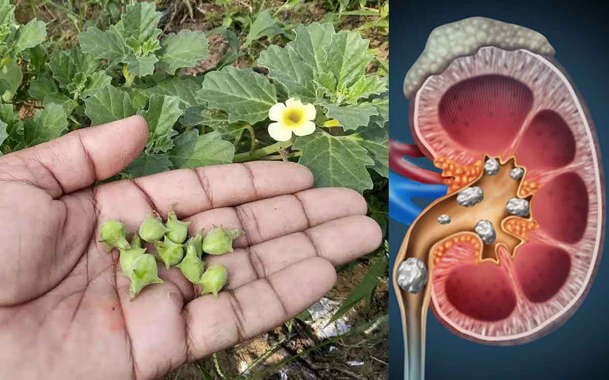 Ayurvedic Remedies For Kidney Stones | కిడ్నీ స్టోన్ల‌ను క‌రిగించే 3 అద్భుత‌మైన ఆయుర్వేద చిట్కాలు..!