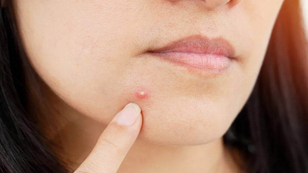 Pimples
