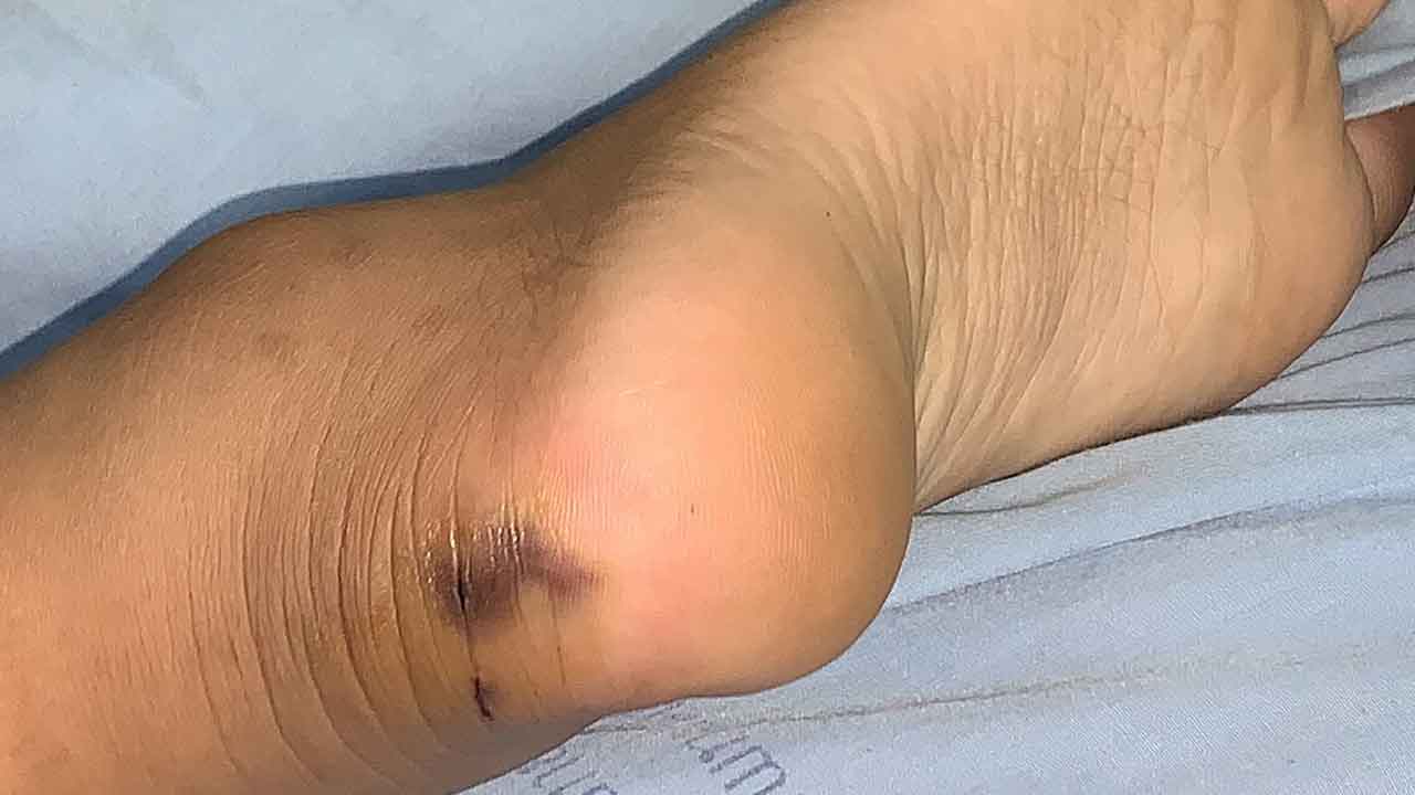 గుర్తించదగ్గ వ్యాధుల జాబితాలో పాము కాటు