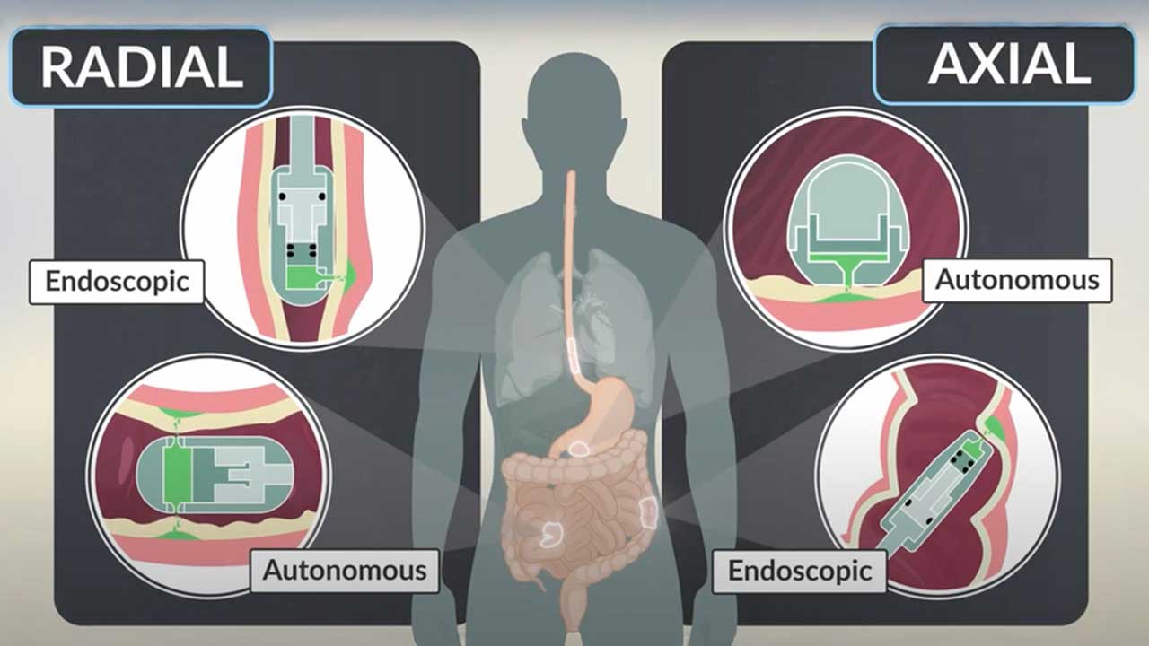 MIT | ఇంజెక్షన్లకు ఇక చెల్లు.. నేరుగా జీర్ణకోశంలోని అవయవాల్లోకి ఔషధం