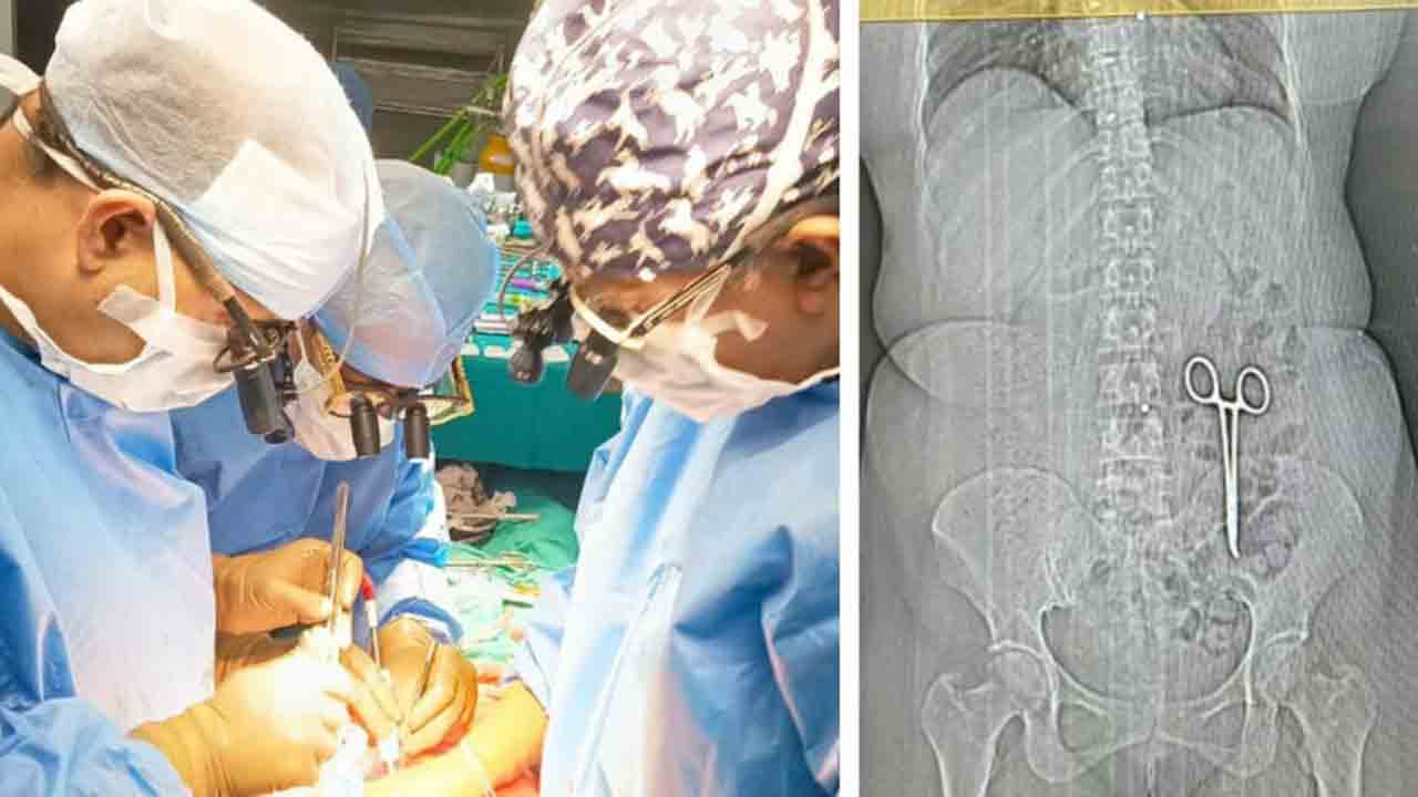 Scissors In Woman’s Stomach | రెండేళ్లుగా మహిళ కడుపులో కత్తెర.. సీటీ స్కాన్‌ ద్వారా   తెలుసుకుని డాక్టర్లు షాక్‌