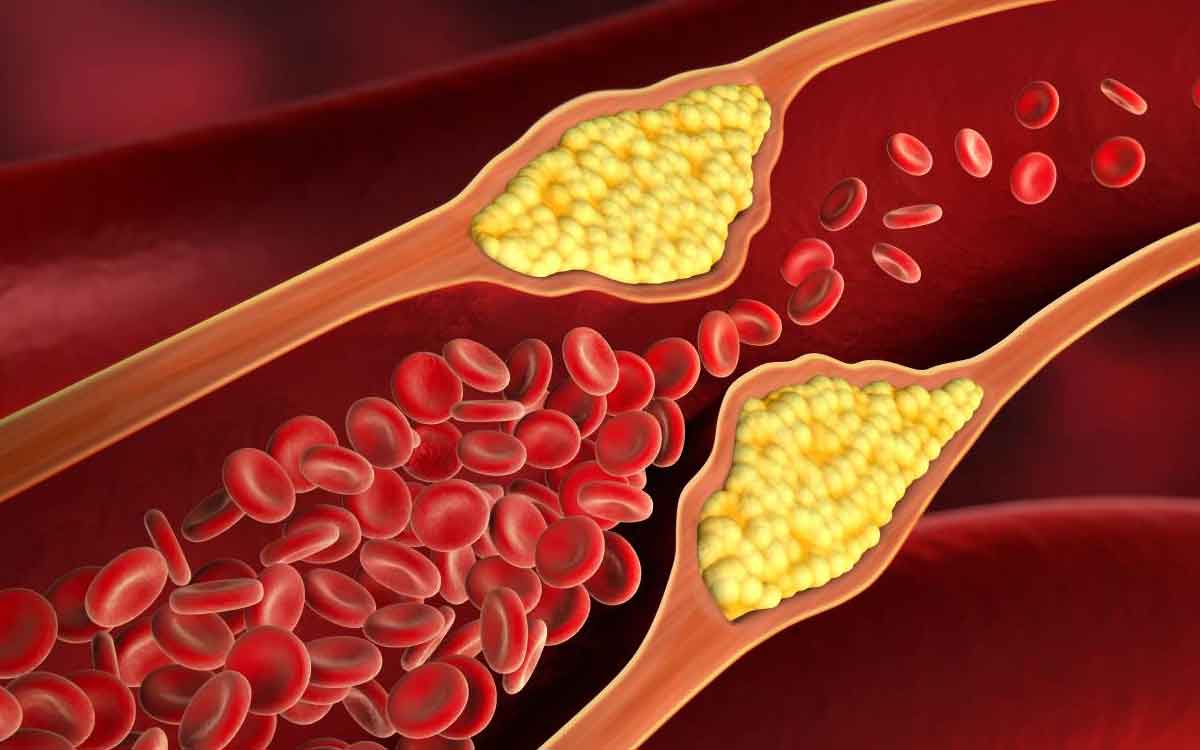 Cholesterol Levels | కొలెస్ట్రాల్ లెవ‌ల్స్‌ను త‌గ్గించుకోవాలంటే.. మీ వంట ఇంట్లో ఉండే వీటిని వాడండి..!